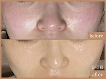 リムーン 岡崎(Re'moon)/REVI ハーブピーリング