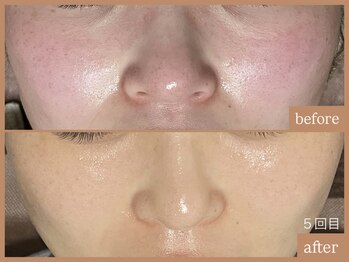 リムーン 岡崎(Re'moon)/REVI ハーブピーリング