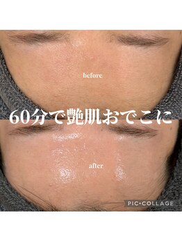 リモナ(Re-mona..)/REVIハーブピーリング