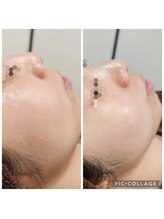 エターナル(Eternal)/ハイブリットピーリング