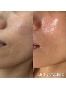 ラ トゥール(La tour)/臍帯・羊膜幹細胞エステ【Lit】