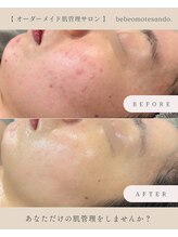 ベベ 表参道(bebe)/二キビに悩む毎日に終止符を