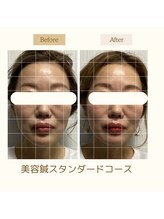 サロン ド ハリッシュ(Salon de HARISH)/美容鍼スタンダードコース