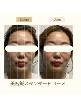 サロン ド ハリッシュ(Salon de HARISH)/美容鍼スタンダードコース