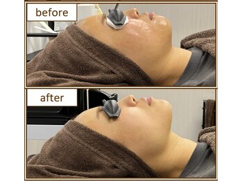 オワゾーブルー(Oiseaubleu)/20代/光フェイシャルたるみ改善