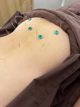 ハリマジック 代官山(HARI MAGIC)/【代官山/鍼灸/美容鍼】