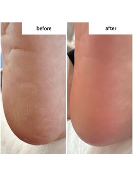 ケアプラス(care plus)/足裏角質ケア