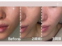 シー センター北(sii)/ララピールで滑らかなシルク肌