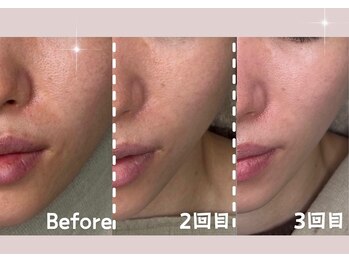 シー センター北(sii)/ララピールで滑らかなシルク肌