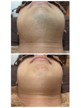 アカラ 読谷店(AKALA)/ヒゲ脱毛１か月半