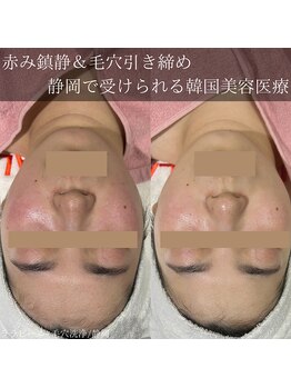 アウラプラス(Aura+)/赤ら顔改善症例/