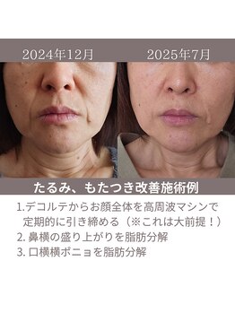 クリニカルスイート エーアール(Clinical sweet.ar)/自然なリフトアップとたるみ改善