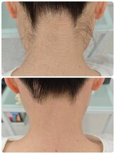 アルマサロン 菊陽(Almasalon)/ムダ毛スッキリ!　うなじ美人