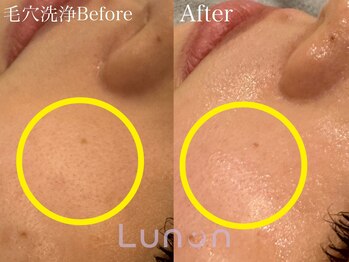 ルノン(Lunon)/毛穴洗浄ハイドロ