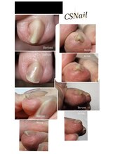 シーエスネイル 元住吉店(CS NAIL)/人差し指の巻き爪