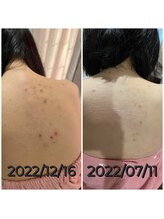 シストワ(sistoi)/★背中のニキビケア★