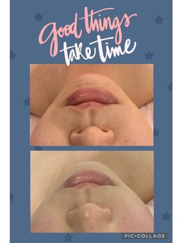 アンリール 旭川店(Anrire)/フェイシャル施術のお客様です!