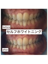 エスデザイン(es design)/セルフホワイトニング／鹿児島