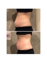 さとう美容整体 町田店/ハイパーナイフEX1回