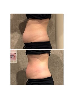 さとう美容整体 町田店/ハイパーナイフEX1回