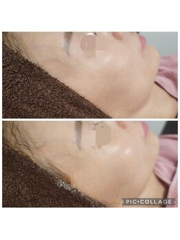 エターナル(Eternal)/ハーブと科学の融合ピーリング