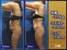 プリオール 高崎花水木店(Prior)の雰囲気（痩身施術のサイズ変化例　ウエスト－9.0cm/ヒップ－7.0cm）