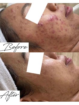 ビズビズ 梅田店(bisebise)/<症例>ニキビケア・跡・赤み