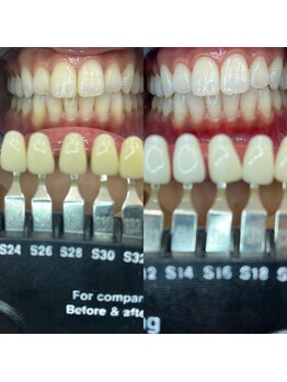 トウキョースワーズ 渋谷店(TOKYO SWRS)/#ホワイトニング #渋谷 #池袋
