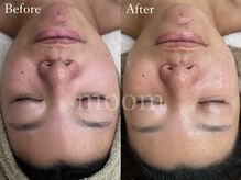 ムーム なんば店(moom)/新メニュー★気になる毛穴へ