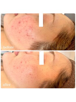 美温(mion)/ハーブピーリング