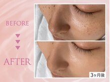 クリアラボ 池袋2nd(Clear Lab)/韓国肌管理&毛穴洗浄専門店