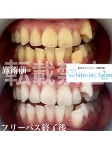 ホワイトニングサロン 熊本店/ホワイトニング学生熊本