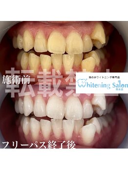 ホワイトニングサロン 熊本店/ホワイトニング学生熊本