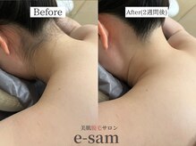 イーサム(e-sam)/丸ごと全身脱毛