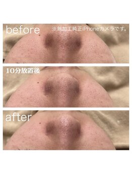 ラクシー 北千住(luxssy)/3D毛穴洗浄