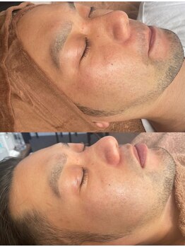 ミナアズアシリ(MINA as asir)/メンズフェイシャル症例写真