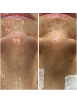 ケイビューティーサロン(K BeautySalon)/ハイドラフェイシャルでツルツル