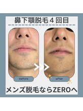 ゼロ 松阪店(ZERO)/鼻下、顎脱毛