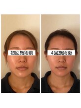 キュープ 浜松店(Qpu)/20代、お悩み：頬骨・輪郭