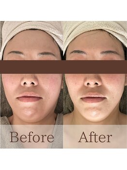 凪眠/小顔リンパフェイシャルの効果26