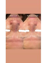 シャンディ(Shandy)/松ヤニエステ&エクソソーム導入