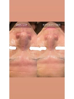 シャンディ(Shandy)/松ヤニエステ&エクソソーム導入