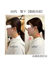 ルーチェエムベルシック(Luce.MBelChic)/顎下の脂肪冷却次フェイシャル