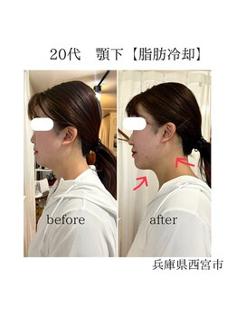 ルーチェエムベルシック(Luce.MBelChic)/顎下の脂肪冷却次フェイシャル