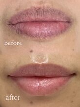 ラミパス(LAMIPAS)/ローマピンク　症例　2ヶ月後