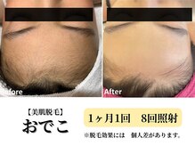 ベルホワイト(Belle White)/【美肌脱毛/おでこ】