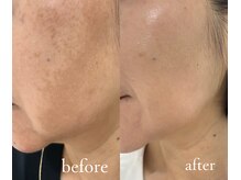 トリートメントルーム フェリーチェ(Felice)/本気の４か月「美白」プログラム