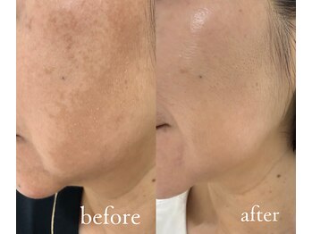 トリートメントルーム フェリーチェ(Felice)/本気の4か月「美白」プログラム