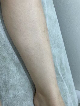 ナノハナ/鹿沼市の全身脱毛のナノハナ