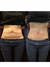 長寿鍼灸院 長寿整骨院/EMS＜お腹集中コース＞